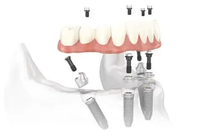 All-on-4™-Konzept: festsitzende Zahnbrücke auf vier Implantaten – Aufbau (Grafik Nobel Biocare)